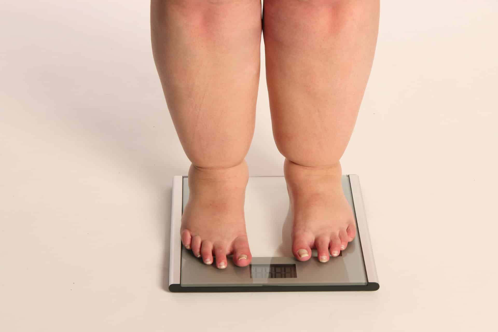 lipedema - choroba grubych nóg
