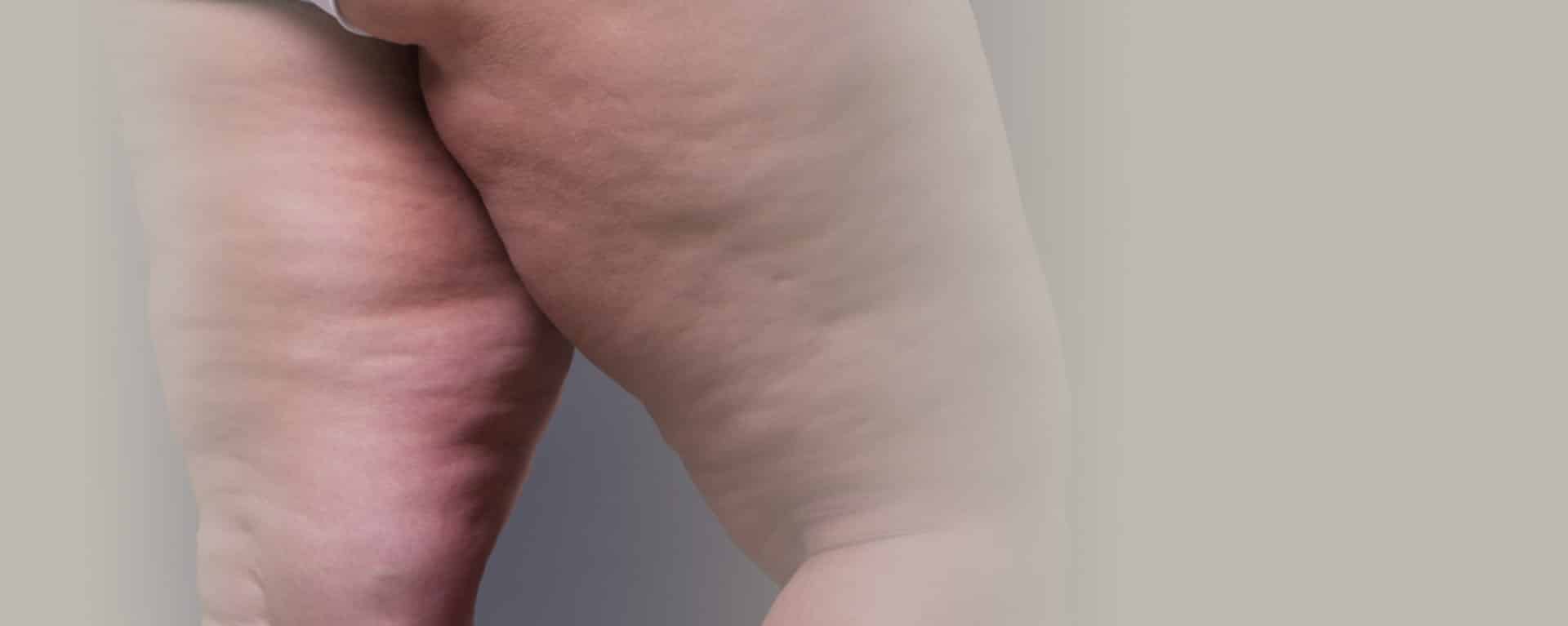 lipedema - jak wygląda